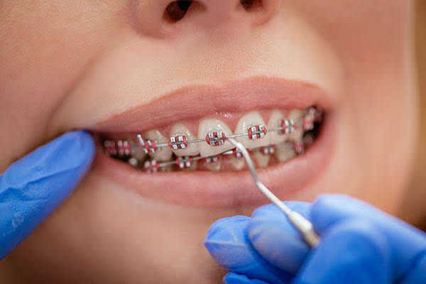 Searching for an Orthodontist Near Me for Braces? Here's What to Know